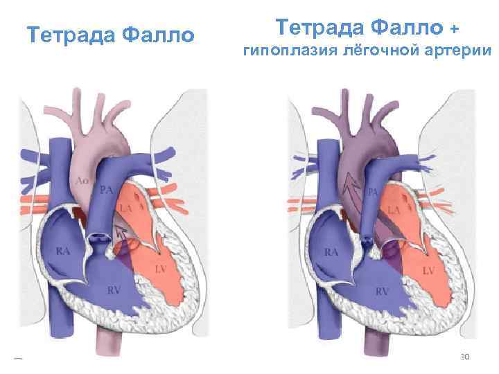 Тетрада фалло клиническая картина