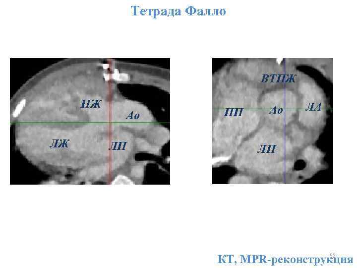 Тетрада Фалло ВТПЖ ПЖ ЛЖ Ао ЛП ПП Ао ЛА ЛП 32 КТ, MPR-реконструкция