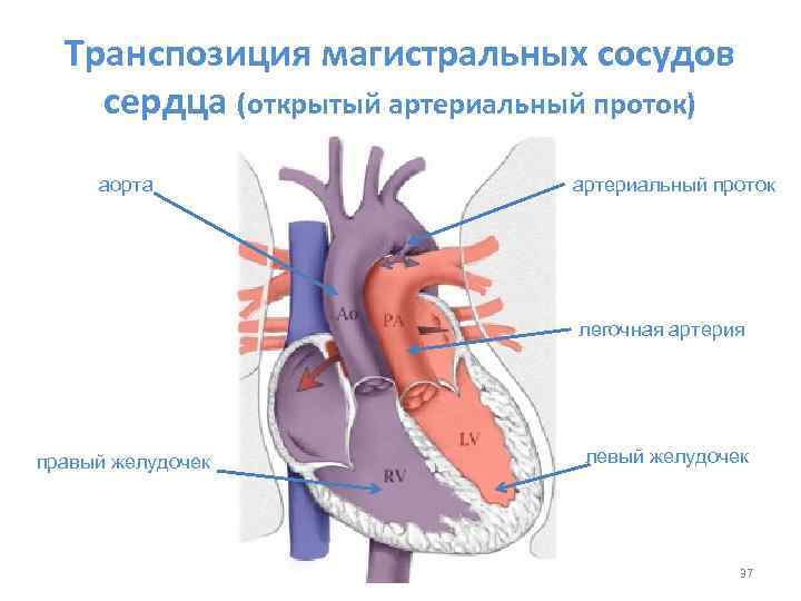 Транспозиция магистральных сосудов сердца (открытый артериальный проток) аорта артериальный проток легочная артерия правый желудочек