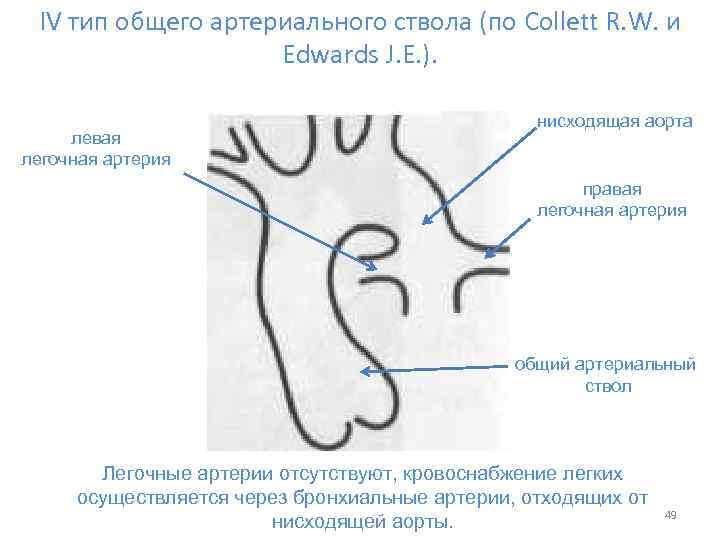 IV тип общего артериального ствола (по Collett R. W. и Edwards J. E. ).