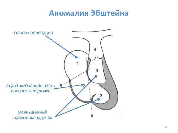 Аномалия Эбштейна правое предсердие атриализованная часть правого желудочка уменьшенный правый желудочек 51 