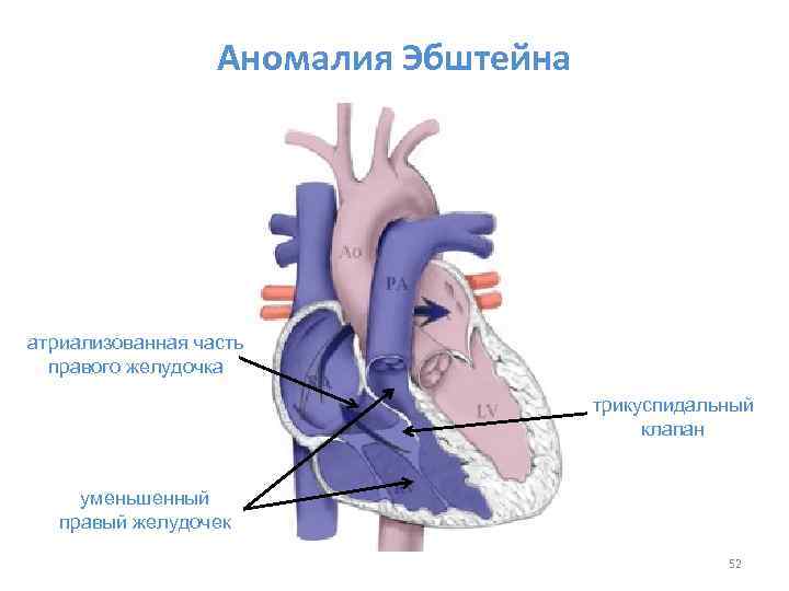 Аномалия Эбштейна атриализованная часть правого желудочка трикуспидальный клапан уменьшенный правый желудочек 52 