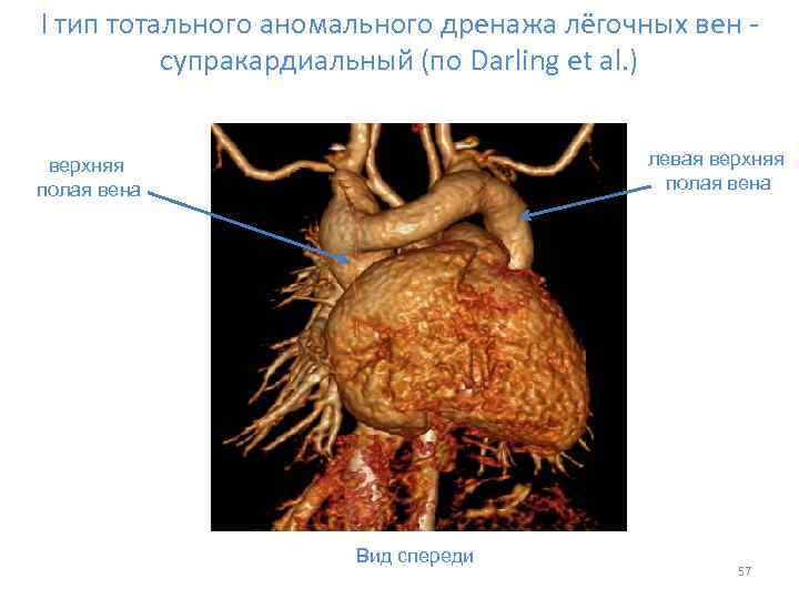 I тип тотального аномального дренажа лёгочных вен - супракардиальный (по Darling et al. )