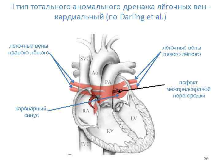 II тип тотального аномального дренажа лёгочных вен - кардиальный (по Darling et al. )