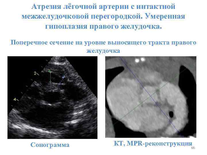 Атрезия лёгочной артерии с интактной межжелудочковой перегородкой. Умеренная гипоплазия правого желудочка. Поперечное сечение на