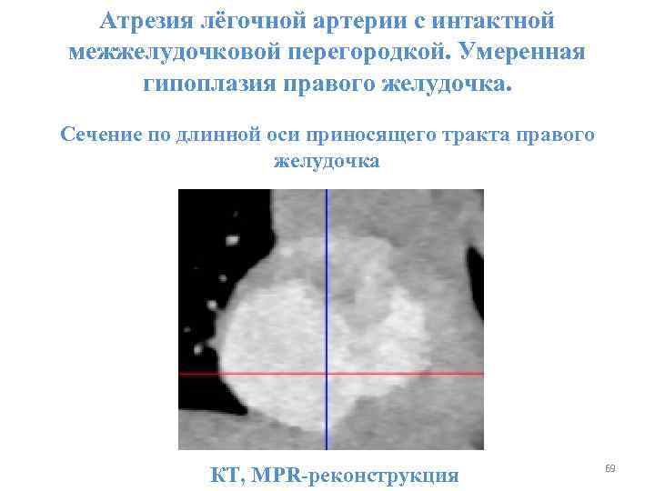 Атрезия лёгочной артерии с интактной межжелудочковой перегородкой. Умеренная гипоплазия правого желудочка. Сечение по длинной