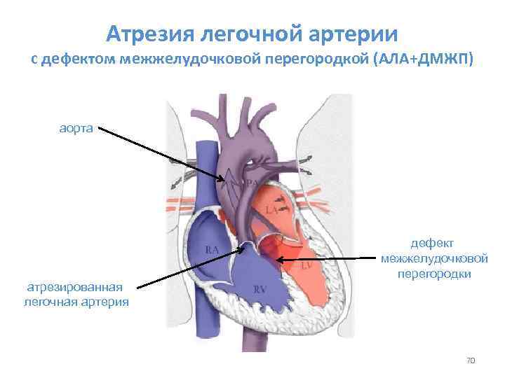 Атрезия легочной артерии с дефектом межжелудочковой перегородкой (АЛА+ДМЖП) аорта атрезированная легочная артерия дефект межжелудочковой