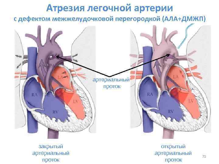 Открытый артериальный проток фото