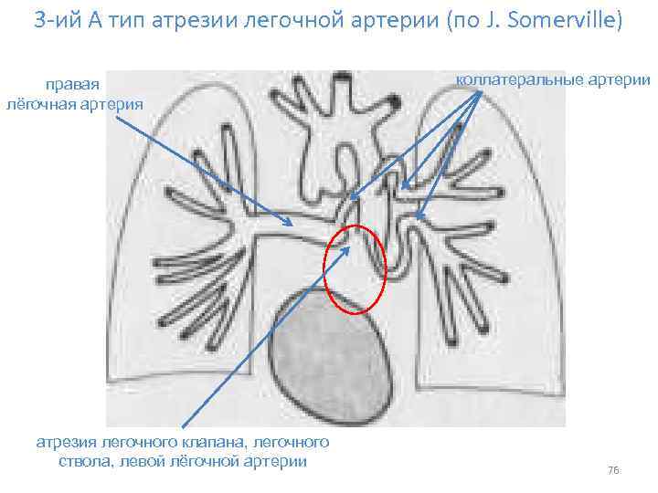 3 -ий А тип атрезии легочной артерии (по J. Somerville) правая лёгочная артерия атрезия