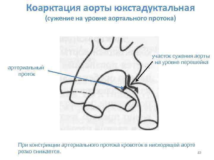 Коарктация аорты форум