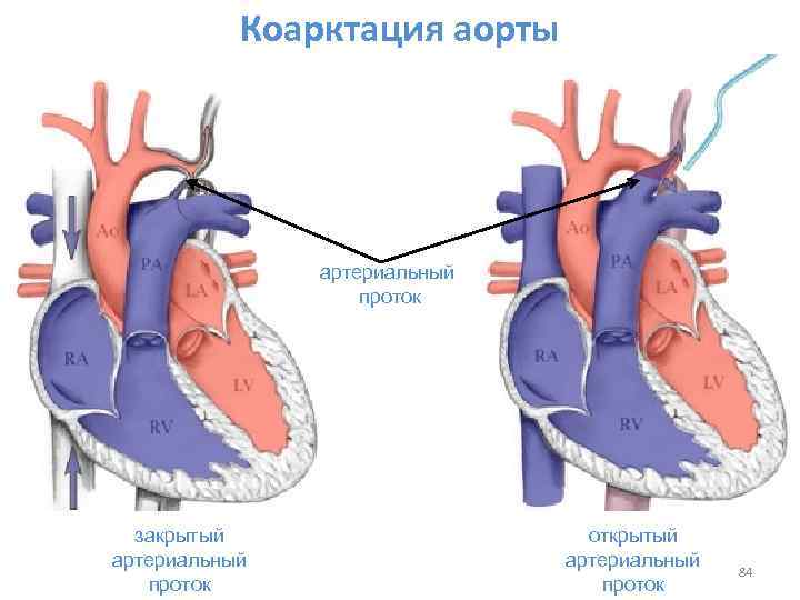 Открытый артериальный проток фото