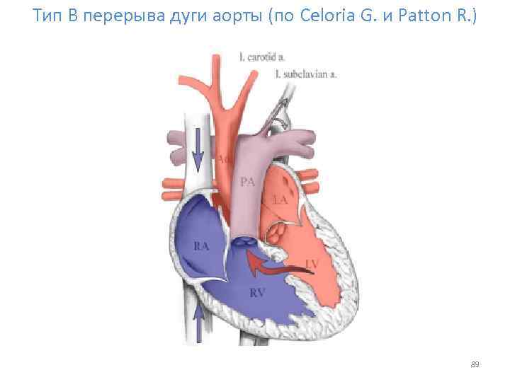 Тип В перерыва дуги аорты (по Celoria G. и Patton R. ) 89 