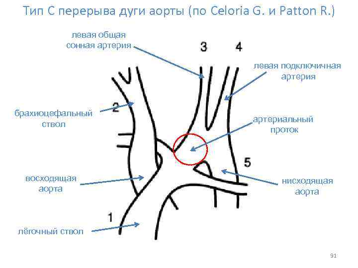 Тип С перерыва дуги аорты (по Celoria G. и Patton R. ) левая общая