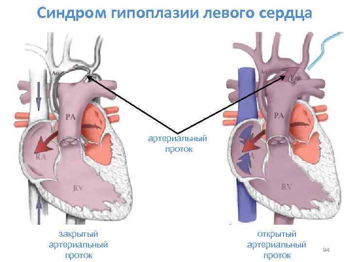 Синдром гипоплазии левого сердца артериальный проток закрытый артериальный проток открытый артериальный проток 94 