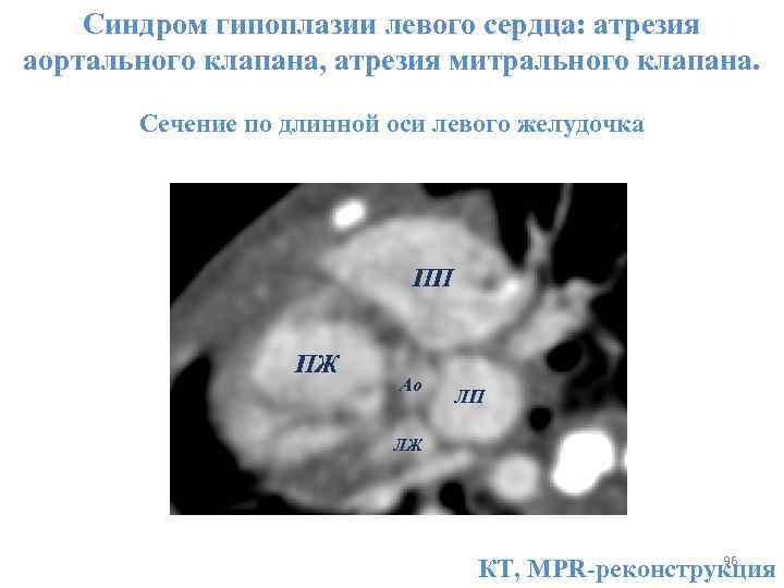 Комиссуротомия митрального клапана это