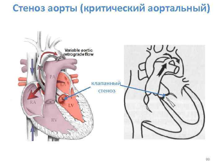 Стеноз аорты у детей презентация