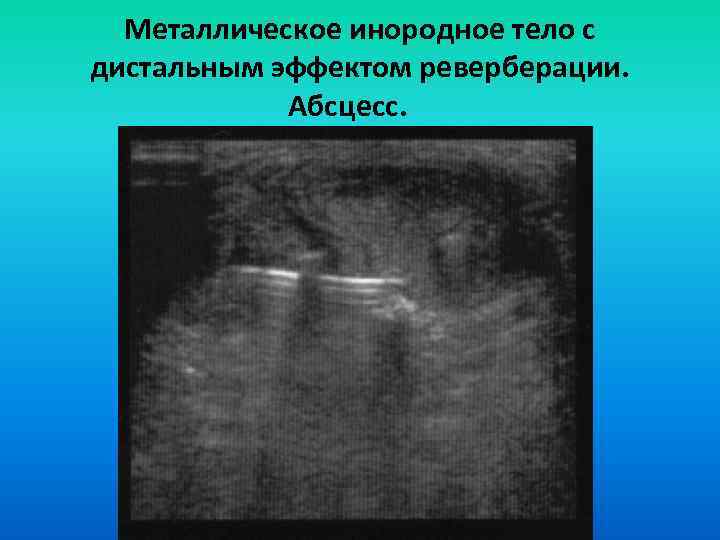 Металлическое инородное тело с дистальным эффектом реверберации. Абсцесс. 