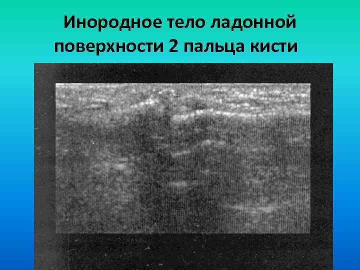 Инородное тело ладонной поверхности 2 пальца кисти 