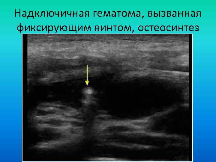 Надключичная гематома, вызванная фиксирующим винтом, остеосинтез 