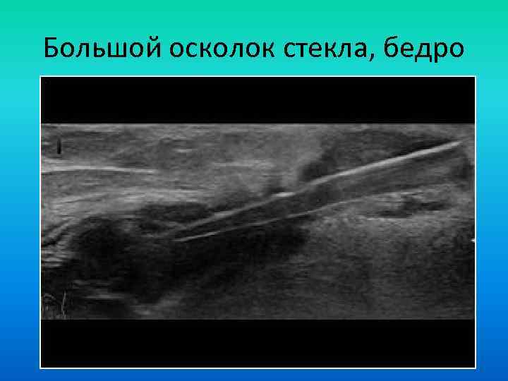 Большой осколок стекла, бедро 