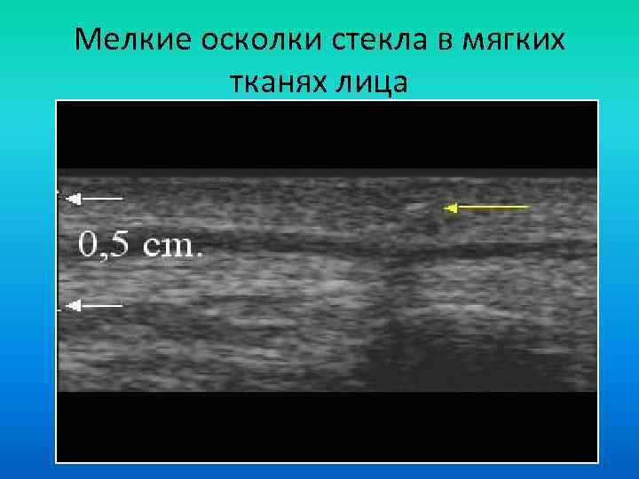 Мелкие осколки стекла в мягких тканях лица 