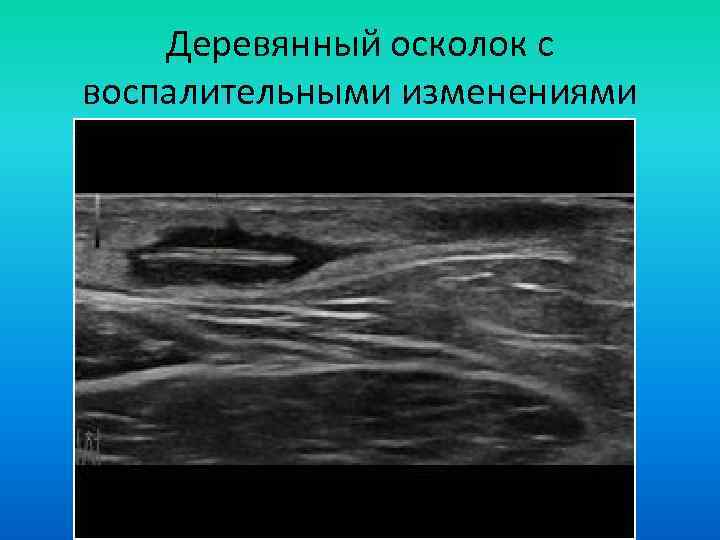 Деревянный осколок с воспалительными изменениями 