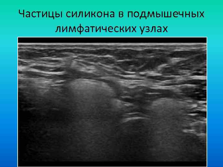 Частицы силикона в подмышечных лимфатических узлах 