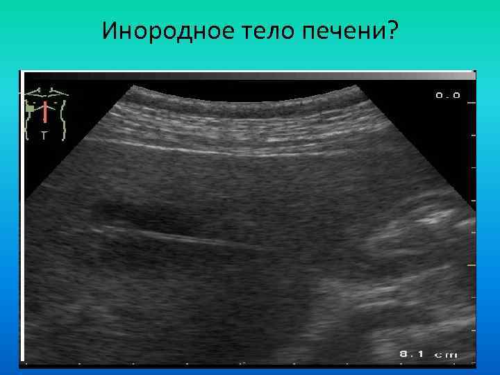 Инородное тело печени? 