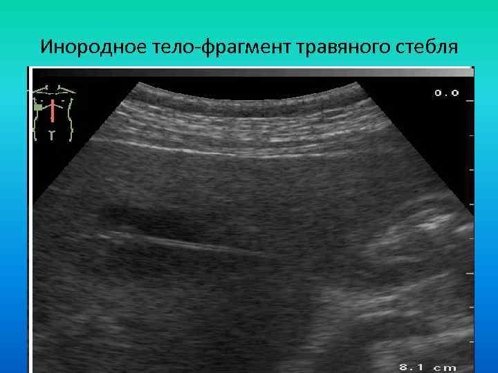 Инородное тело-фрагмент травяного стебля 