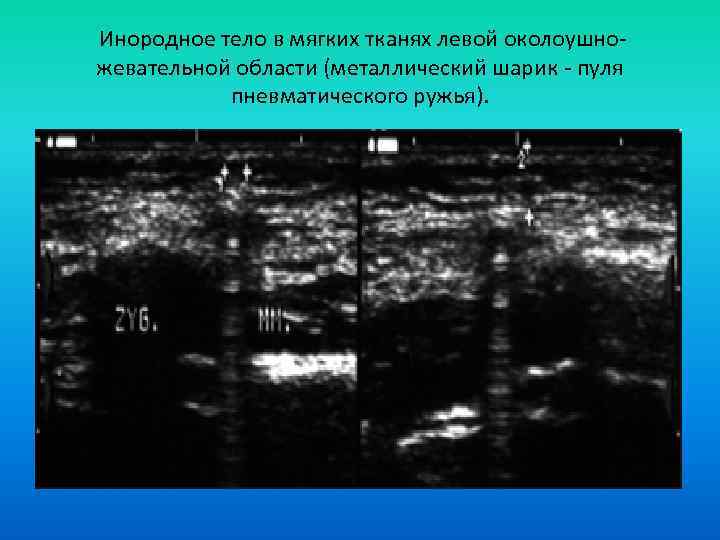  Инородное тело в мягких тканях левой околоушножевательной области (металлический шарик - пуля пневматического