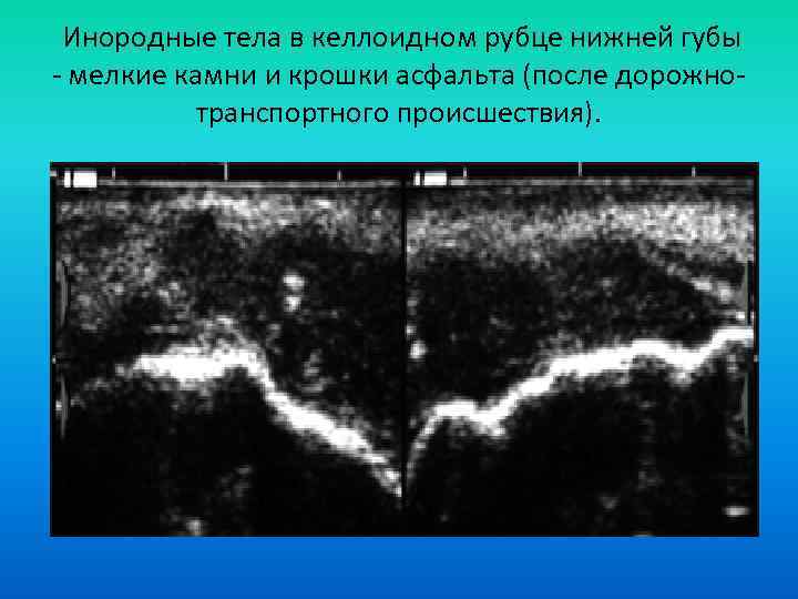  Инородные тела в келлоидном рубце нижней губы - мелкие камни и крошки асфальта