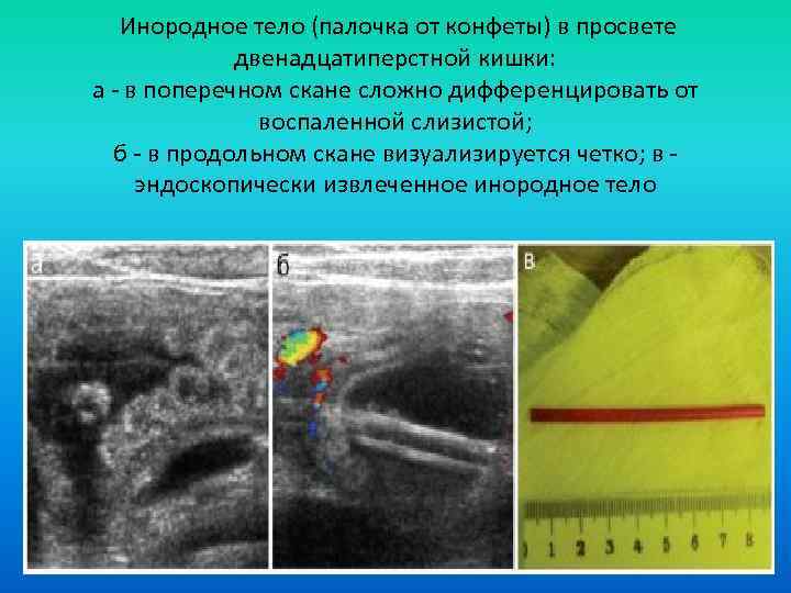  Инородное тело (палочка от конфеты) в просвете двенадцатиперстной кишки: а - в поперечном