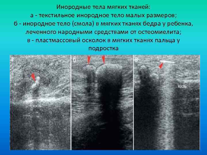 Инородные тела мягких тканей: а - текстильное инородное тело малых размеров; б - инородное