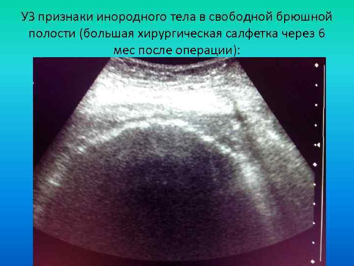 УЗ признаки инородного тела в свободной брюшной полости (большая хирургическая салфетка через 6 мес