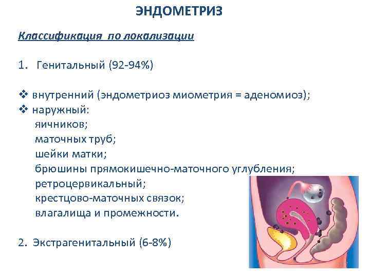 ЭНДОМЕТРИЗ Классификация по локализации 1. Генитальный (92 -94%) v внутренний (эндометриоз миометрия = аденомиоз);