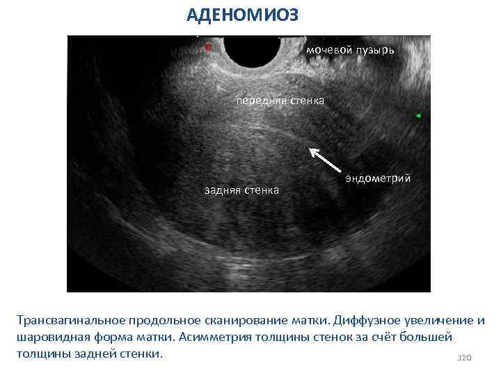 Что значит расширенная матка. Узловая форма аденомиоза матки на УЗИ. Диффузный эндометриоз матки УЗИ.