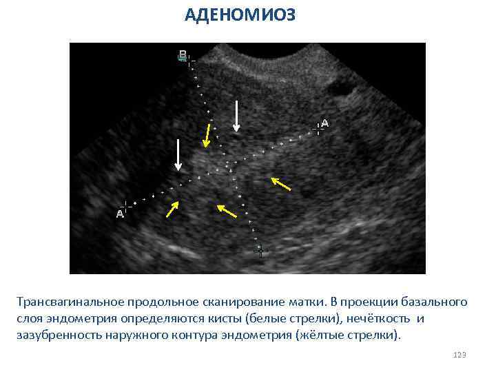 Обратное развитие эндометрия. УЗИ протокол аденомиоза матки. Базальный слой эндометрия.