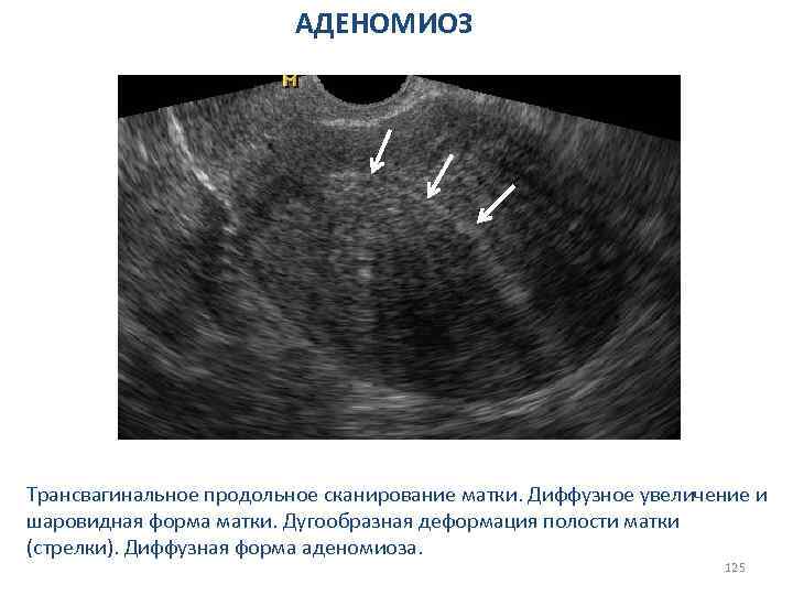 АДЕНОМИОЗ Трансвагинальное продольное сканирование матки. Диффузное увеличение и шаровидная форма матки. Дугообразная деформация полости