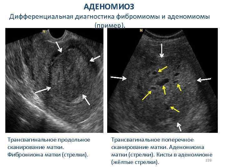 АДЕНОМИОЗ Дифференциальная диагностика фибромиомы и аденомиомы (пример). Трансвагинальное продольное сканирование матки. Фибромиома матки (стрелки).