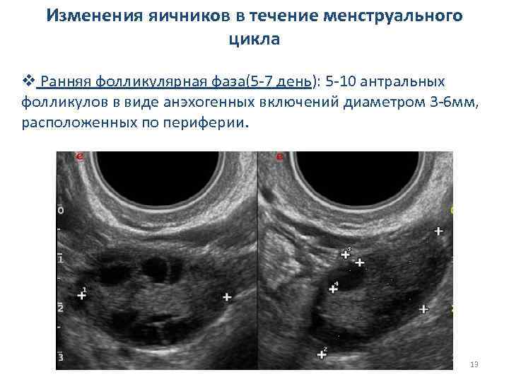 Изменения яичников в течение менструального цикла v Ранняя фолликулярная фаза(5 -7 день): 5 -10