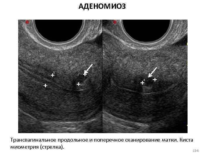 Эхографическая картина аденомиоза