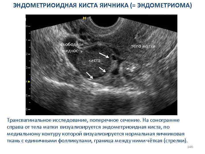 ЭНДОМЕТРИОИДНАЯ КИСТА ЯИЧНИКА (= ЭНДОМЕТРИОМА) шейка матки киста свободная жидкость тело матки киста Трансвагинальное