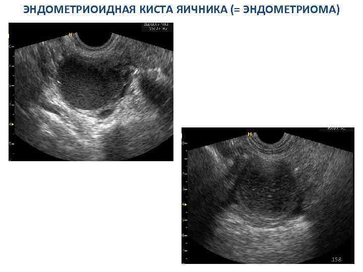 Лютеиновая киста яичника на узи фото