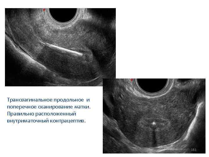 Трансвагинальное продольное и поперечное сканирование матки. Правильно расположенный внутриматочный контрацептив. 161 