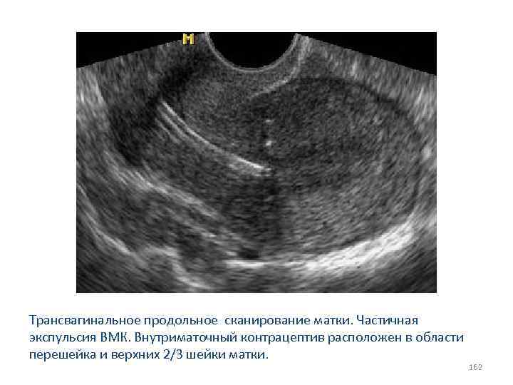 Трансвагинальное продольное сканирование матки. Частичная экспульсия ВМК. Внутриматочный контрацептив расположен в области перешейка и