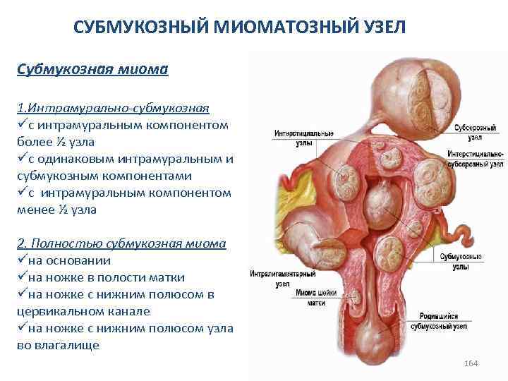 СУБМУКОЗНЫЙ МИОМАТОЗНЫЙ УЗЕЛ Субмукозная миома 1. Интрамурально-субмукозная üс интрамуральным компонентом более ½ узла üс