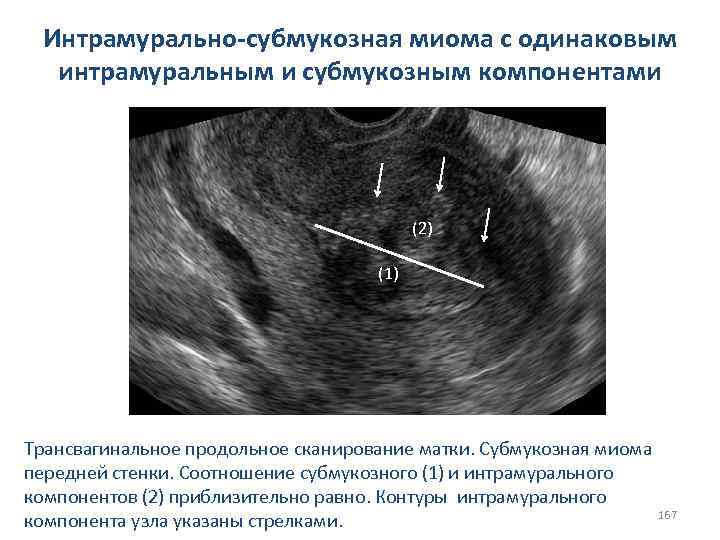 Интрамурально-субмукозная миома с одинаковым интрамуральным и субмукозным компонентами (2) (1) (2) Трансвагинальное продольное сканирование