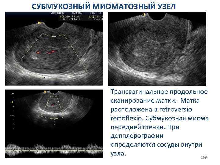 СУБМУКОЗНЫЙ МИОМАТОЗНЫЙ УЗЕЛ Трансвагинальное продольное сканирование матки. Матка расположена в retroversio rertoflexio. Субмукозная миома