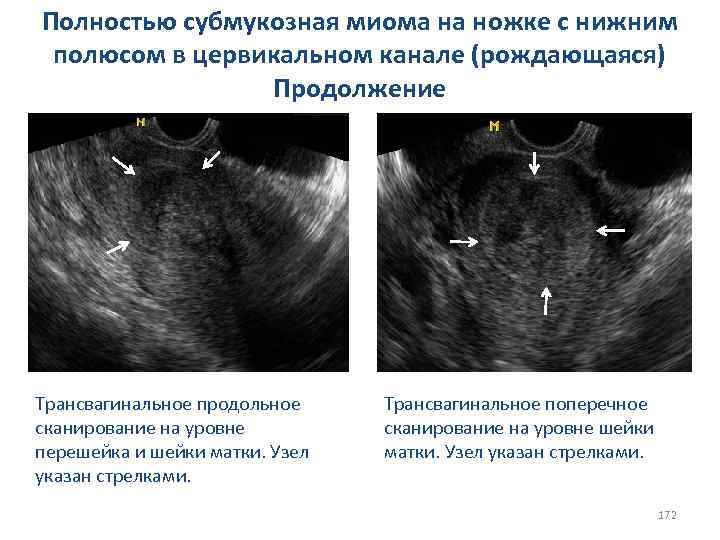 Полностью субмукозная миома на ножке с нижним полюсом в цервикальном канале (рождающаяся) Продолжение Трансвагинальное