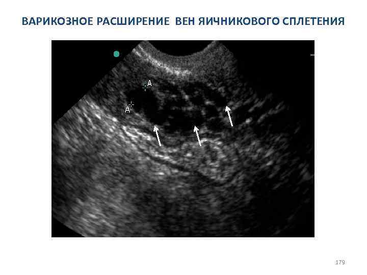 ВАРИКОЗНОЕ РАСШИРЕНИЕ ВЕН ЯИЧНИКОВОГО СПЛЕТЕНИЯ 179 